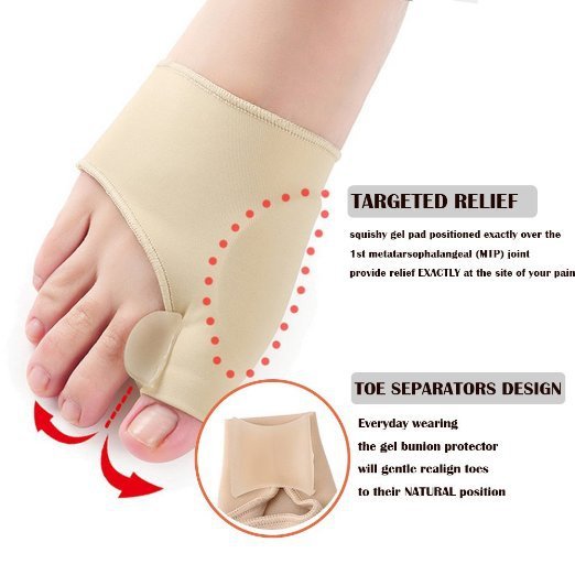 Teenstand corrector bij scheve grote teen (Hallux Valgus)